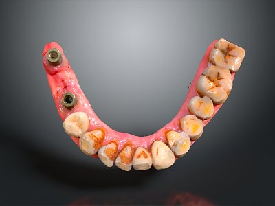 Dental Implant Modern Teeth model