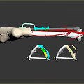 3D Bone Model With Implant Components Red Lines And Surgical Support Devices 3d model