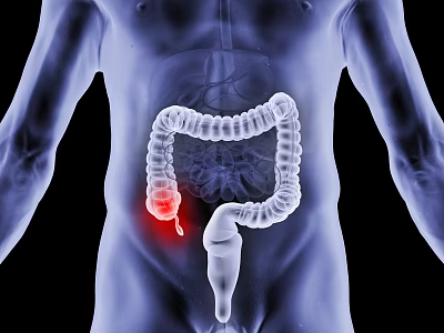 Human Abdominal Intestines Detailed Anatomical Illustration With Highlighted Inflamed Section 3d model
