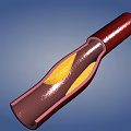 Man Examining Blood Vessel Interior With Yellow Plaque Buildup Structure 3d model