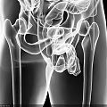 Medical Imaging Device For 3D Rendering Of Human Pelvis And Digestive System
