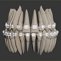 Dental Teeth Model Displaying Clear Orthodontic Braces For Teeth Alignment 3d model