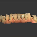 Dental Teeth Model With White Restored Teeth And Pink Gum Base For Dental Study