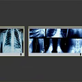 Medical X-ray Illuminators With Clear Display Of Lung And Bone Implant Films