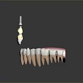 3D Model Of Oral Dental Medical Device Implant Abutment With Prosthetic Teeth