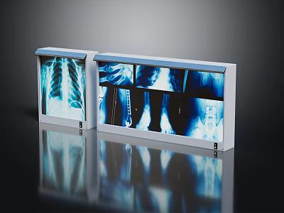 Medical X-ray Illuminators With Clear Display Of Lung And Bone Implant Films 3d model