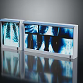 Medical X-ray Illuminators With Clear Display Of Lung And Bone Implant Films