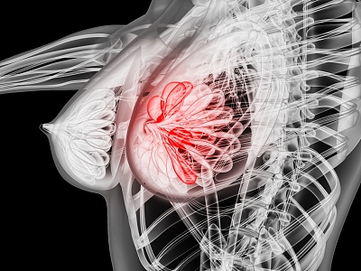 modern human breast lesions model