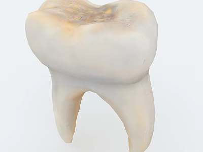 3D Human Molar Tooth Model Showing Decay And Cavity Damage 3d model