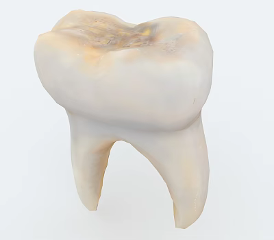 3D Human Molar Tooth Model Showing Decay And Cavity Damage 3d model