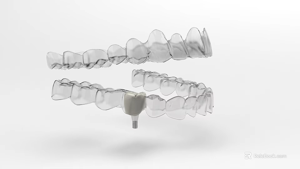 Transparent Dental Crowns Model With Implant Structure For Teeth Restoration 3d model 