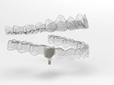 Transparent Dental Crowns Model With Implant Structure For Teeth Restoration 3d model