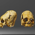 Two Human Skulls Showing Lateral And Frontal Views With Yellowish Cracks And Spots