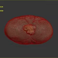 Medical Device Anatomical Organ Model with Yellow Pathological Lesion for Training