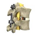 3D Model Of Human Spine With Metal Fixation Screws And Implants