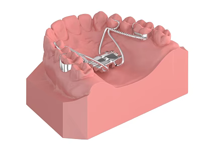 Dental Medical Device with Metal Framework on Teeth Model for Fixation 3d model