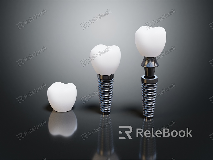 Modern Dental Implant Dental Implant model