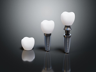 Modern Dental Implant Dental Implant model