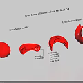 Medical Device Showing Normal vs Sickled Red Blood Cell Cross Sections for Sickle Cell Anemia