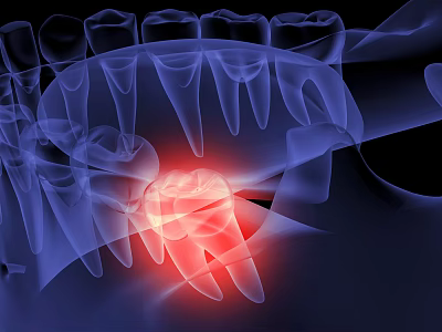 Dental Medical Device Showing Highlighted Tooth Structure In X Ray Examination 3d model