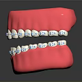 Pink Dental Model With Metal Braces And Blue Brackets On Teeth