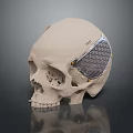 3D Printed Metal Mesh Cranial Implant Medical Device for Skull Reconstruction Surgery