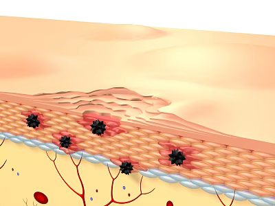 modern skin lesions 3d model