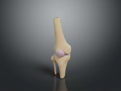 Knee Joint Medical Device 3D Model for Orthopedic Implant and Surgical Planning 3d model