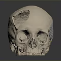 3D Printed Metal Mesh Cranial Implant Medical Device for Skull Reconstruction Surgery
