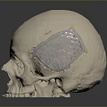 3D Printed Metal Mesh Cranial Implant Medical Device for Skull Reconstruction Surgery