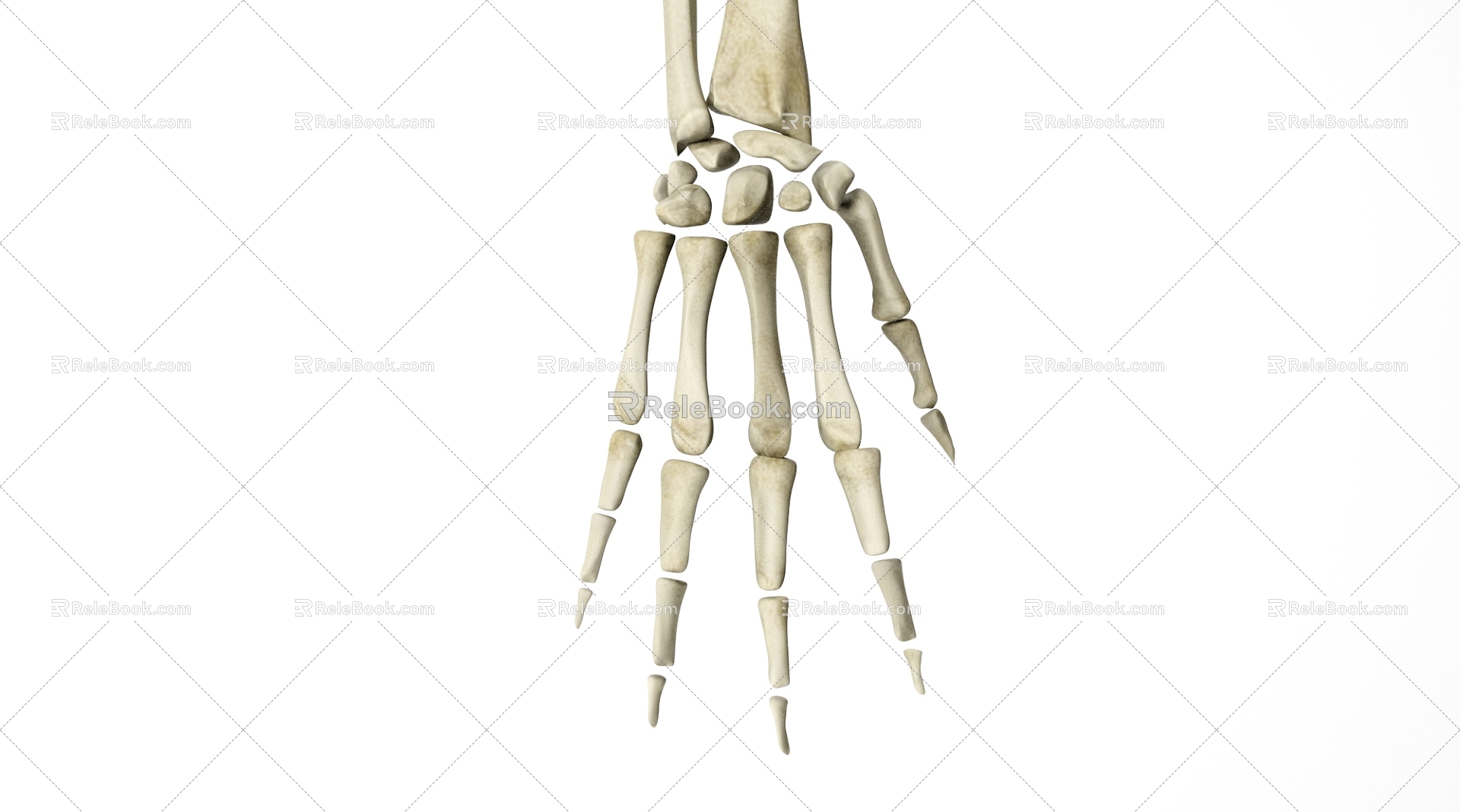 Modern Skeletal Lesion Scene Skeletal Lesion 3d model