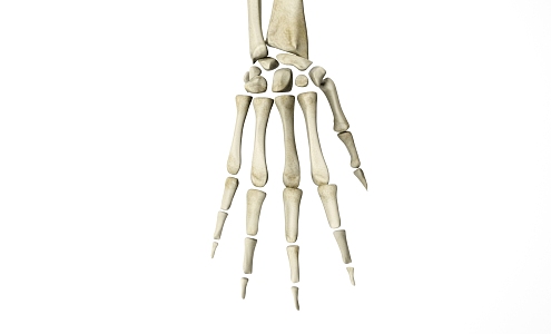 Modern Skeletal Lesion Scene Skeletal Lesion 3d model