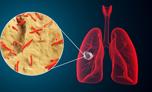 Modern lung disease 3d model