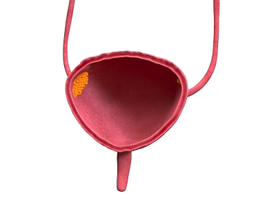 Bladder cancer Anatomy Human tissue Bladder cancer Diseases 3d model