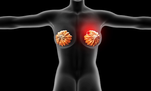 modern human breast lesions 3d model