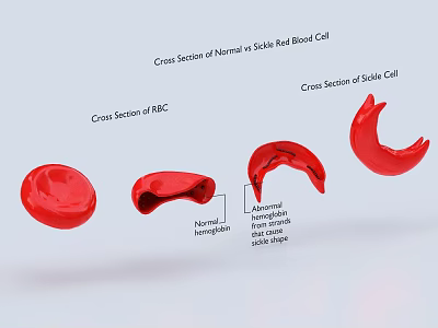 Medical Device Showing Normal vs Sickled Red Blood Cell Cross Sections for Sickle Cell Anemia 3d model