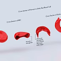 Medical Device Showing Normal vs Sickled Red Blood Cell Cross Sections for Sickle Cell Anemia