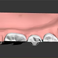 Dental Implant Medical Device With Tooth Structure And Bone Model