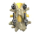 3D Model Of Human Spine With Metal Fixation Screws And Implants