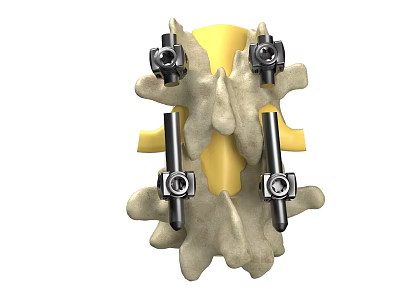 3D Model Of Human Spine With Metal Fixation Screws And Implants 3d model