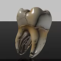 Man With Cracked Damaged Tooth Showing Severe Dental Health Problems