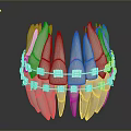 Dental Teeth Model Displaying Clear Orthodontic Braces For Teeth Alignment 3d model