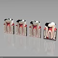 Dental Organ Structure Models Showing Healthy And Decayed Tooth Stages 3d model