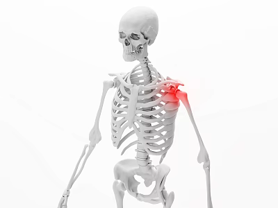 Modern human scapulohumeral periarthritis 3d model Modern human scapulohumeral periarthritis 3d model