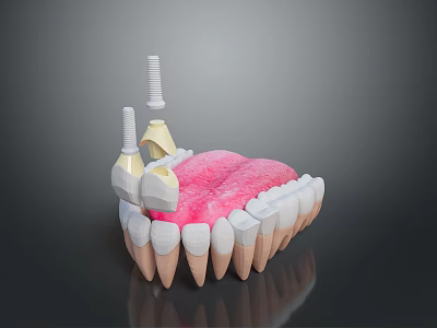 3D Model Of Oral Dental Medical Device Implant Abutment With Prosthetic Teeth 3d model