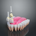 3D Model Of Oral Dental Medical Device Implant Abutment With Prosthetic Teeth