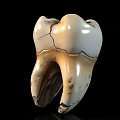 Man With Cracked Damaged Tooth Showing Severe Dental Health Problems