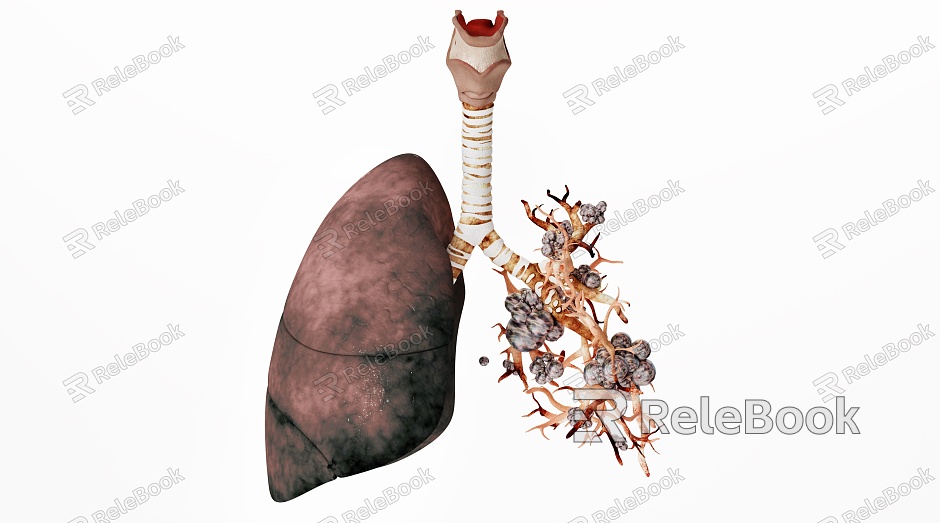 modern lung disease model