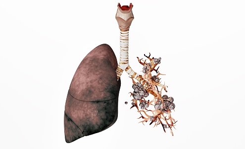 modern lung disease 3d model