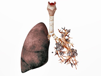 modern lung disease 3d model